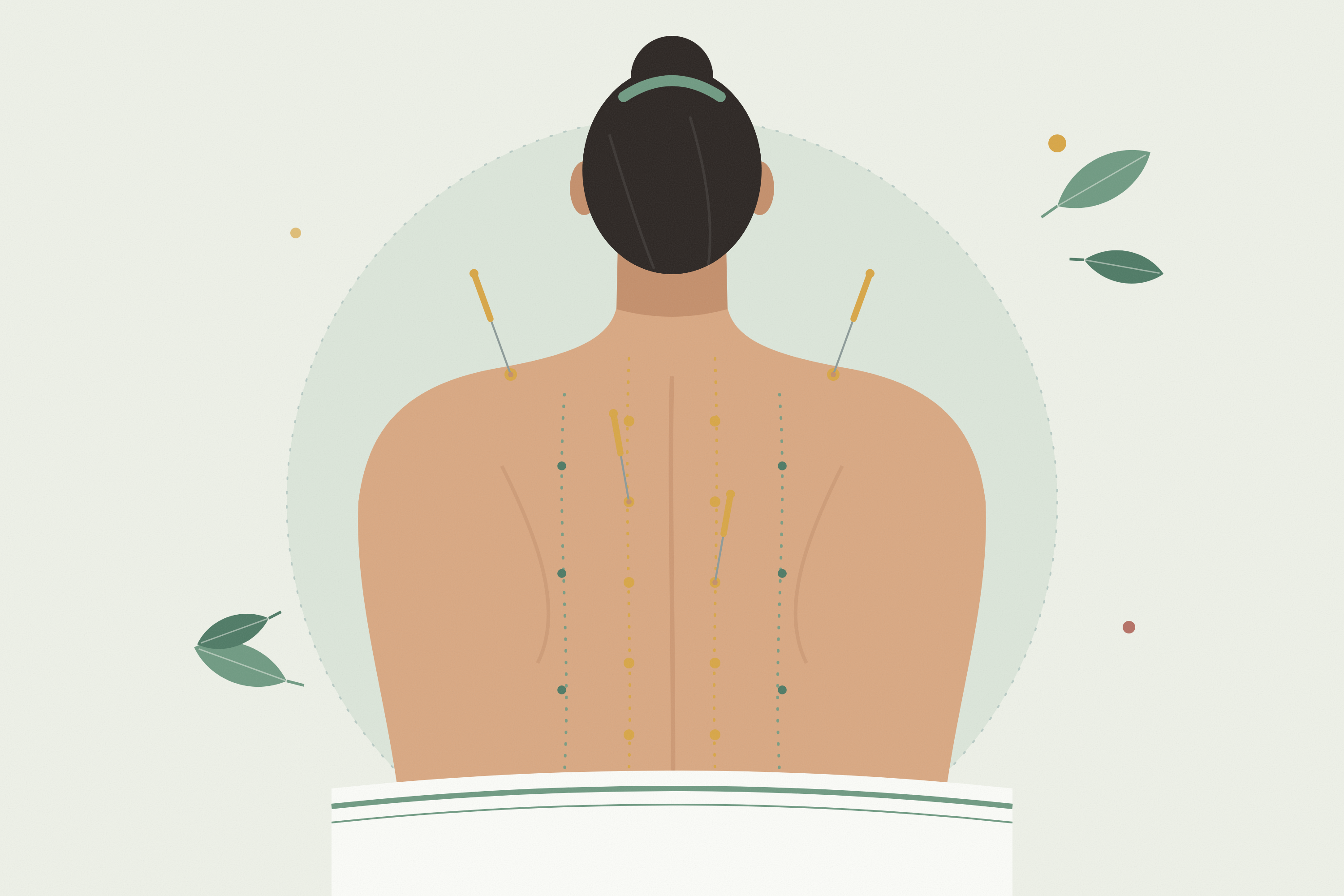 Acupuncture needles along meridian points on the back