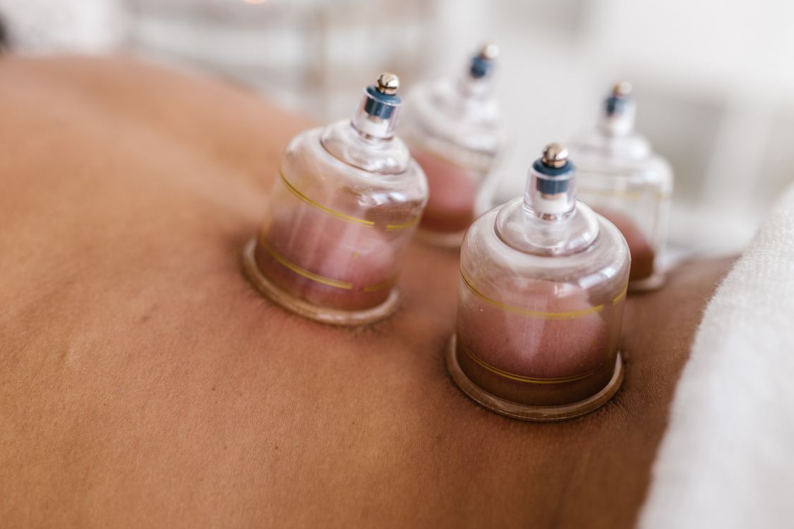 Glass cupping cups applied to a patient's back during a therapy session